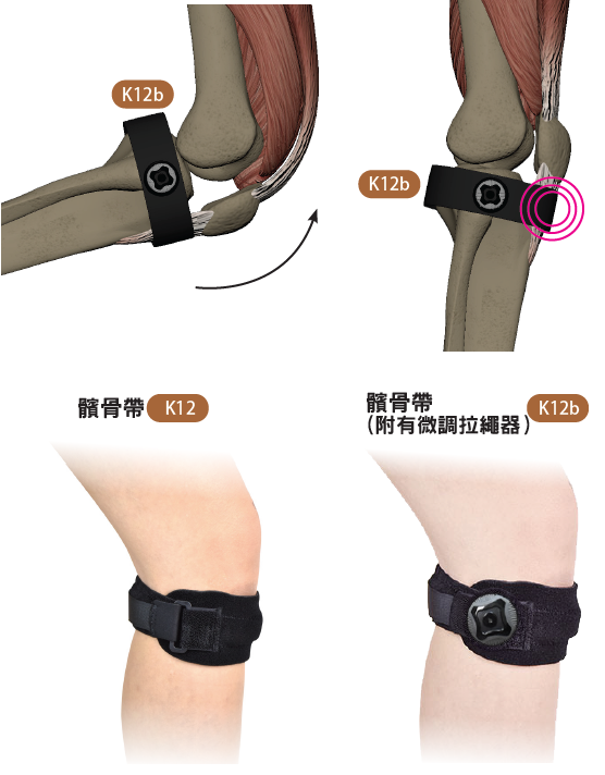 髕腱炎